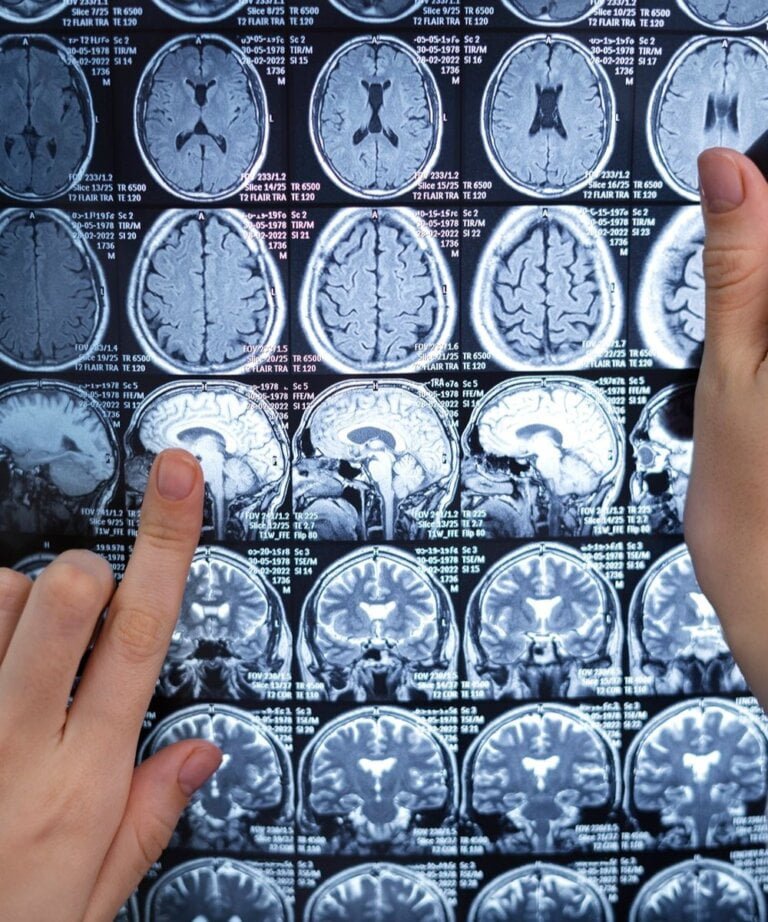 Neuro Spine and Headache Clinic Gurgaon 6 Send Your Query to Dr. Nitisha Goyal